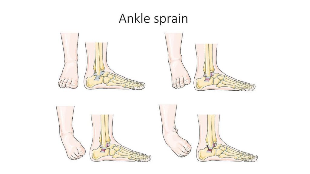 Ankle Sprain