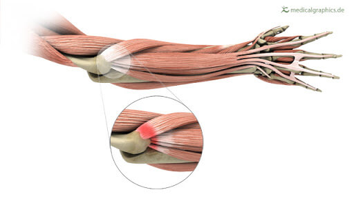 Tennis Elbow