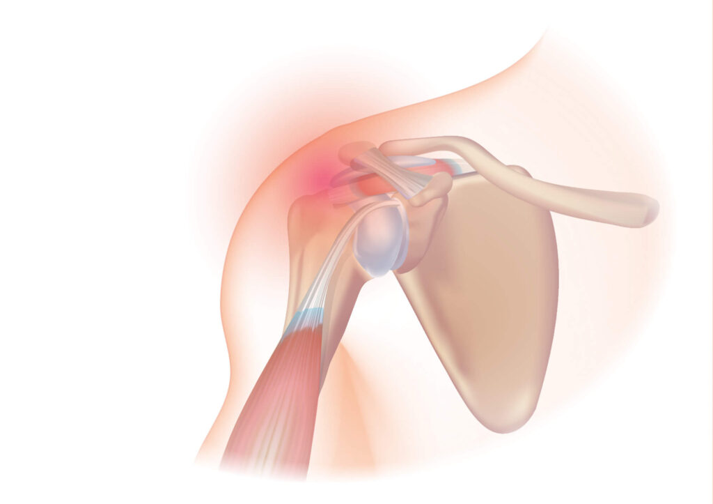 Rotator Cuff Tears